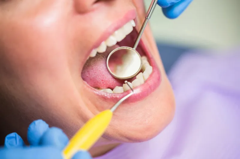 Dental Sealant