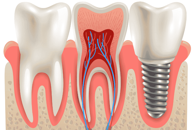 Dental Implants